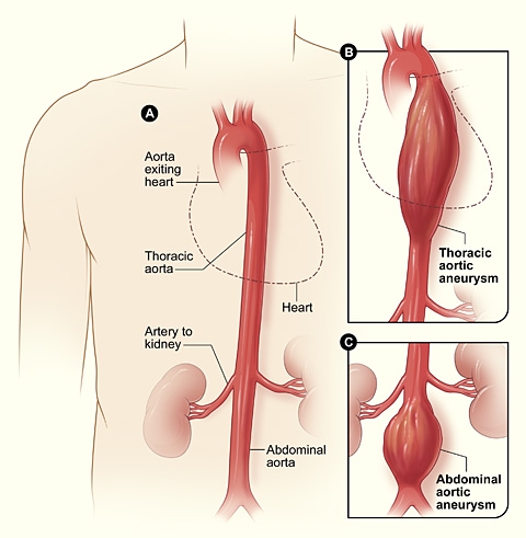 Fumatul si anevrismul aortic abdominal